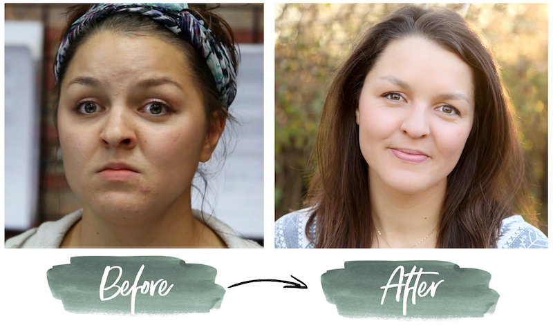 Before and after acne holistic living transformation