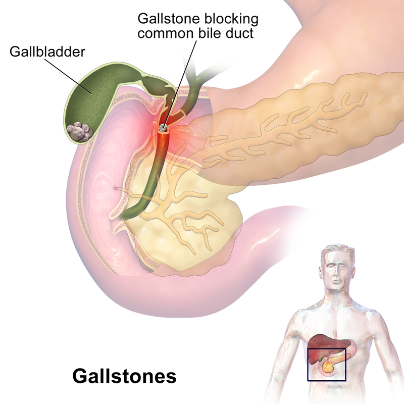 Gallstones and the gallbladder