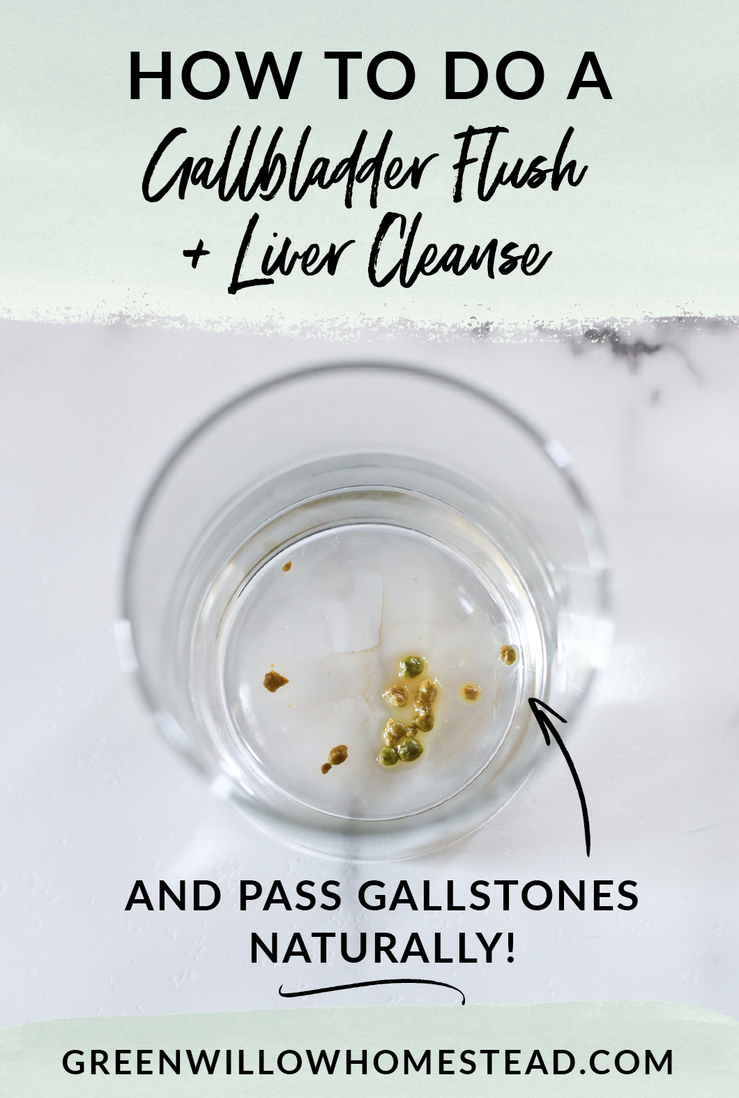 Pass gallstones naturally without surgery using the gallbladder flush